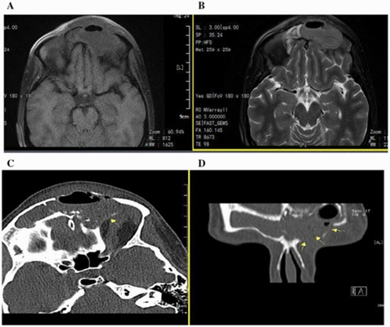 Endoscopic sinus surgery for Pott's tumor in pregnancy {faces}