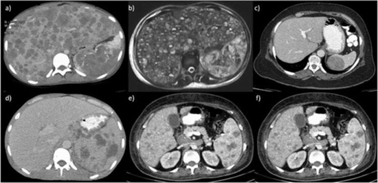 Diagnostic performance of different imaging modalities for splenic malignancies {faces}