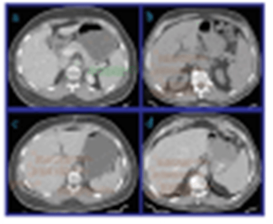 Correction to: Reliability assessment of CT in liver fibrosis prediction {faces}