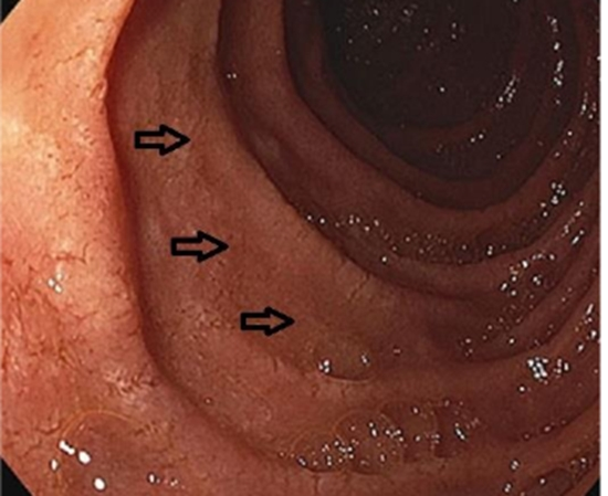 Ultrasonographic Assessment of Intima-Media Thickness {faces}