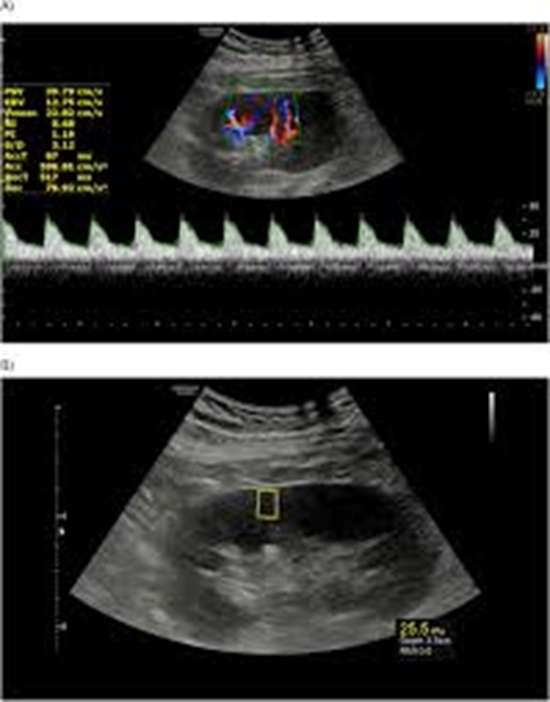 Doppler US and US Elastography is Superior to Doppler US or US Elastography {faces}
