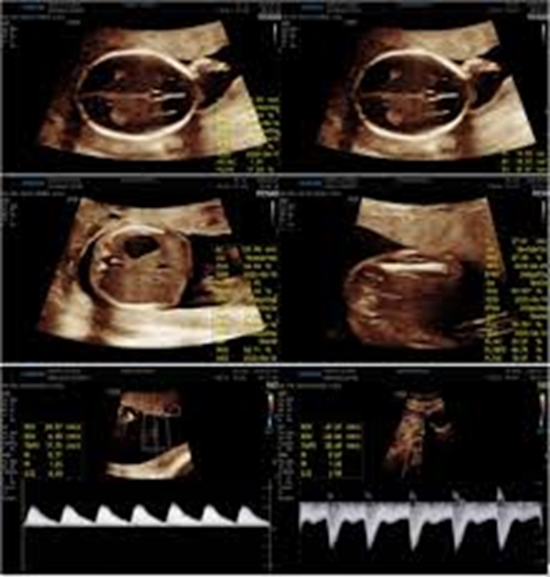 Placental Thickness in Fetal Biometric Assessment and Doppler Indices of the Uterine and Umbilical Arteries  {faces}