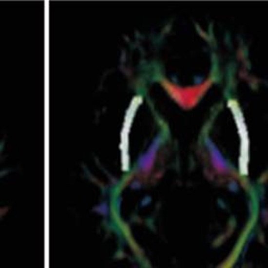 Age-dependent brain subcortical white and gray matter disruptions {faces}