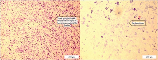 Expanded intravenous mesenchymal chondrosarcoma with clinical presentation of deep vein thrombosis {faces}