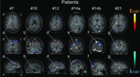 Perfusion-weighted MRI patterns in neuropsychiatric systemic lupus erythematosus {faces}