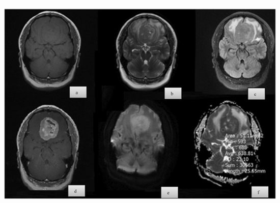 Diffusion-Weighted Imaging and Histopathologic Findings of Meningioma {faces}