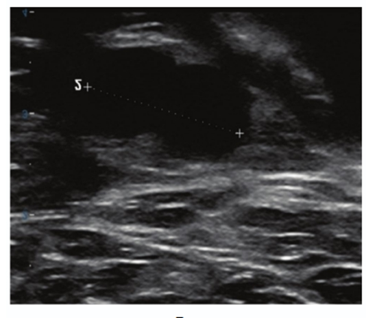 Sonographic Correlations With Histological Grade and Biomarker Profiles in Breast Invasive Ductal Carcinoma {faces}