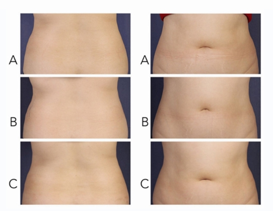 Evaluating the Efficacy and Safety of Deoxycholic Acid Injection in Reduction of Flank Fat {faces}