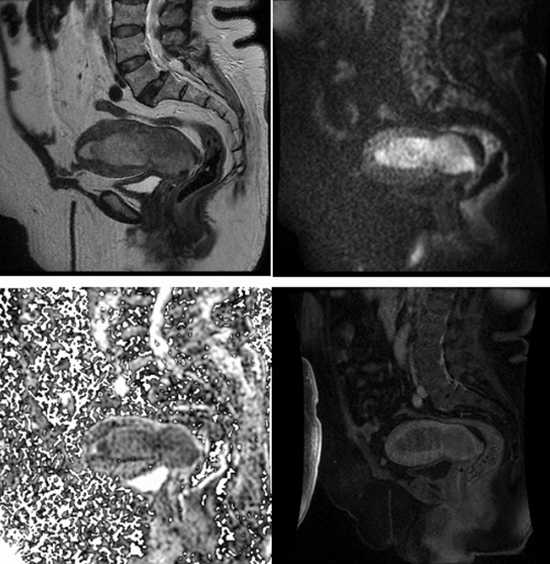 MRI Prediction Model for Anatomical Site Identification in Uterine Carcinoma {faces}