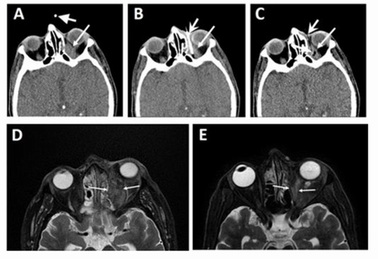 CT-Scan Intra-orbital Amphotericin Injection in COVID-19 {faces}