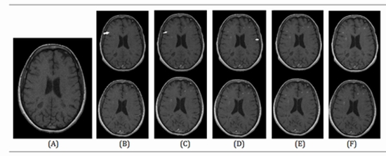 Gadovist and Magnevist in Brain mri of ms {faces}