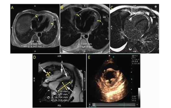 Diagnostic of MRI and Echocardiography in Constrictive Pericarditis {faces}