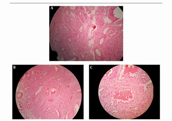 MRI Features of Diffuse Cavernous Hemangioma {faces}