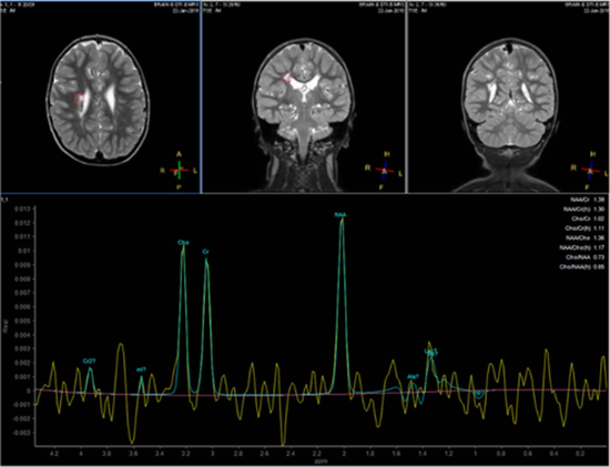 Stem Cell Therapy Effects on Brain Metabolism in Cerebral Palsy {faces}