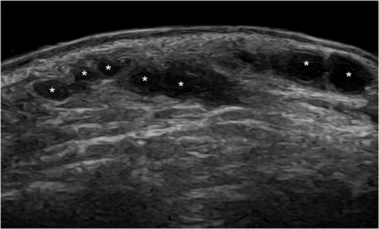 Ultrasonographic evaluation of cosmetic fillers 