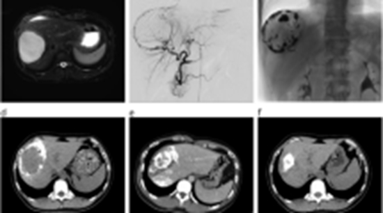Commentary on Thermal Ablation for Giant Hepatic Hemangiomas 