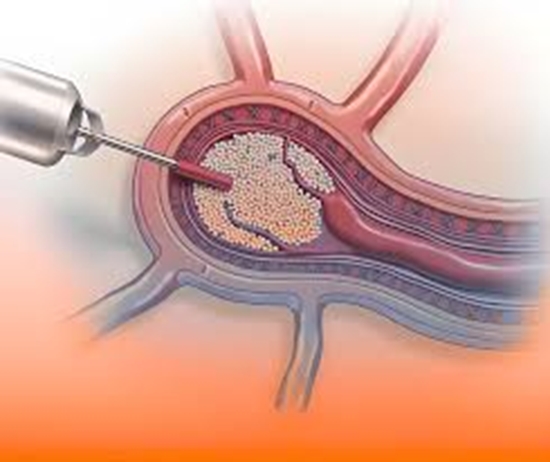 Arterial Embolization for the Internal Hemorrhoids Management {faces}