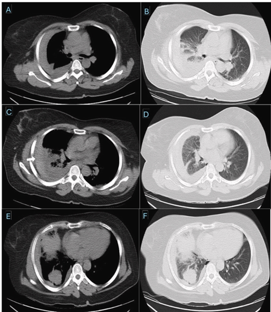 Massive hemothorax following CT-guided lung biopsy {faces}