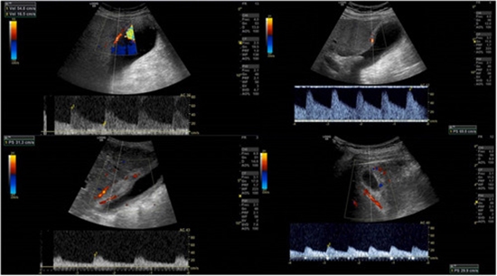 Diagnostic value of cystic artery colour Doppler ultrasound indices in acute cholecystitis {faces}