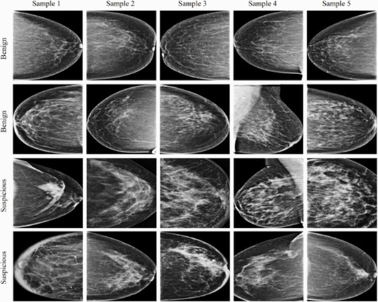 Two-level breast tumor classification with multi-view imaging and pathology-aware large language models {faces}