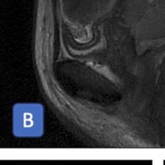 Diagnostic utility of apparent diffusion coefficient values in cervical cancer staging {faces}