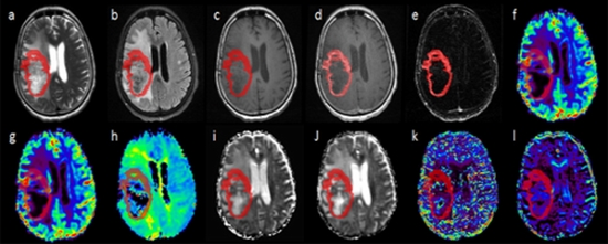  Differentiation Between Pseudoprogression and True Progression in High-Grade Glioma {faces}