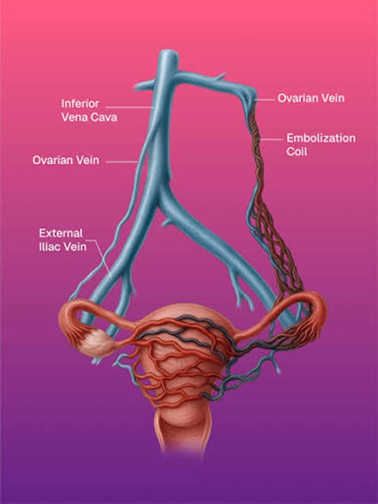 Optimizing Venographic Referrals in Pelvic Congestion Syndrome {faces}