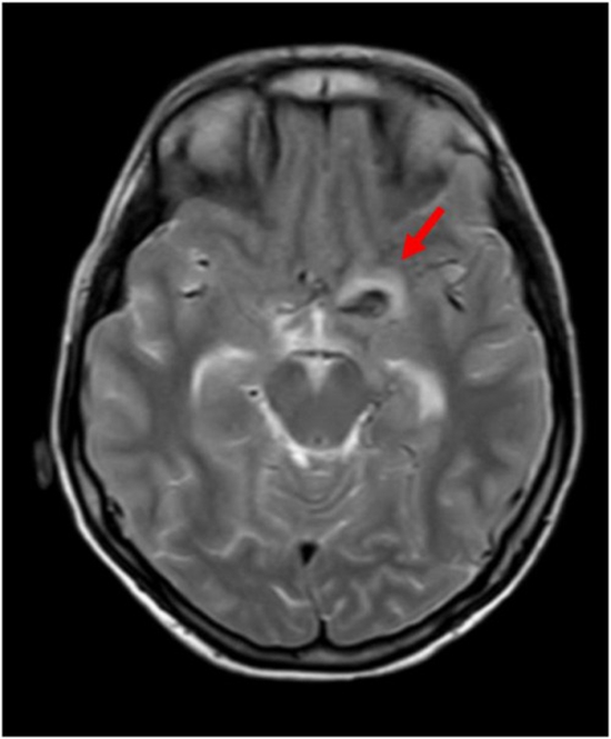  intracranial internal carotid artery aneurysm masquerading as meningitis {faces}