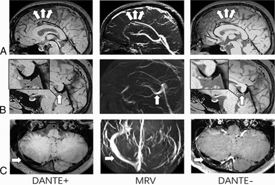 MR black-blood thrombus imaging in cerebral venous thrombosis {faces}