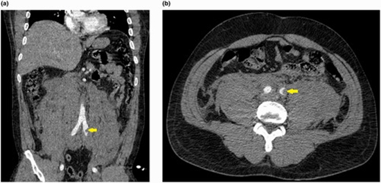 Fatal Spontaneous Retroperitoneal Hematoma Following Physical Exertion {faces}