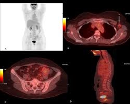 No Restriction on DWI and Low Uptake in PET CT in Breast Lobular Cancer {faces}