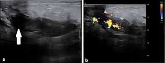 Ultrasound findings in the early diagnosis of idiopathic granulomatous mastitis {faces}