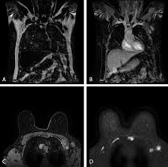 MRI in Detecting Axillary Lymph Node Metastasis in Breast Cancer {faces}