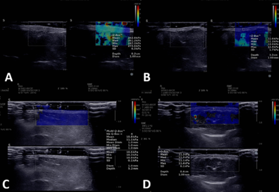 Ultrasound and shear-wave elastography  for evaluating response to treatment of morphea {faces}