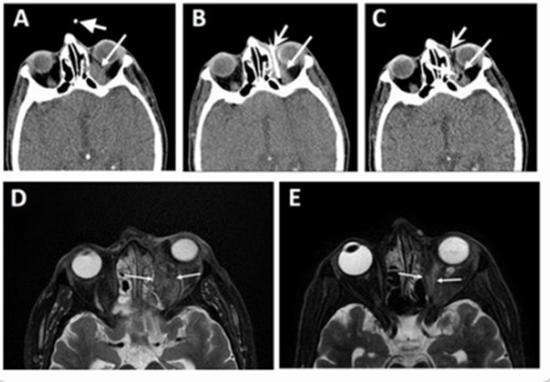CT Scan Guided Intra-orbital Amphotericin Injection in COVID19 {faces}