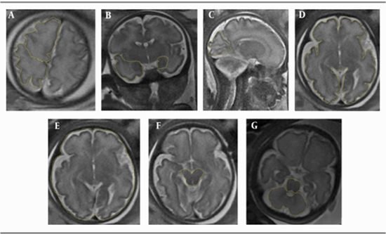  Brain Cortical Thickness and Area of Different Lobes  {faces}