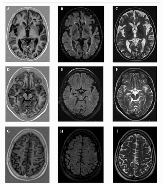 Phase Sensitive Inversion Recovery and Conventional Magnetic Resonance Imaging {faces}