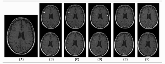 Comparison of Gadovist and Magnevist in Brain Magnetic Resonance Imaging of Multiple Sclerosis  {faces}