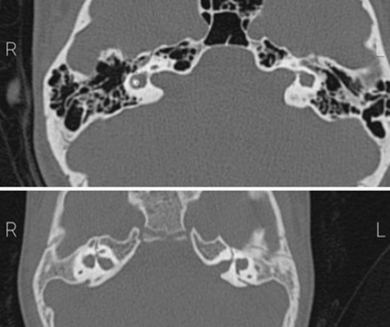 CT Scan and Audiogram Findings in Ears with Lateral Semicircular Canal Dysplasia {faces}