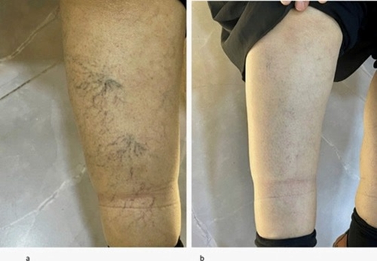 Treating Chronic Venous Disease After Intra-arterial Stem Cell Injection  {faces}