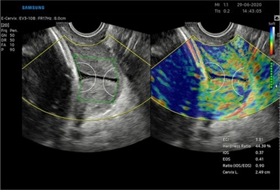Diagnostic of ultrasound elastography for uterine cervical neoplasm {faces}