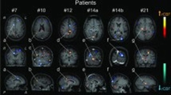 MRI patterns in neuropsychiatric systemic lupus erythematosus {faces}