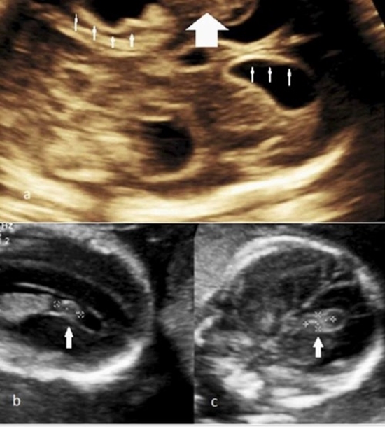 Fetal intracranial hemorrhage and infarct {faces}