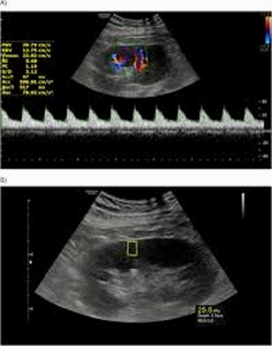 Doppler US and US Elastography is Superior to Doppler US or US Elastography {faces}