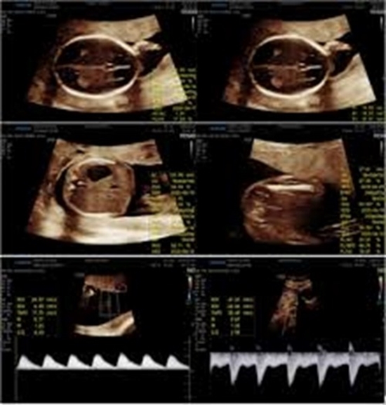  Placental Thickness in Fetal Biometric Assessment and Doppler Indice {faces}