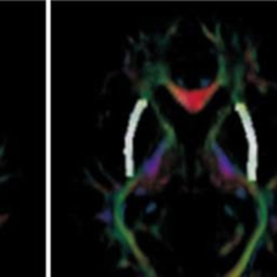Age dependent brain subcortical white and gray matter disruptions {faces}
