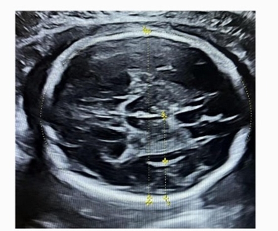 Impact of Intrauterine Growth Restriction on Fetal Cortical Brain Development {faces}