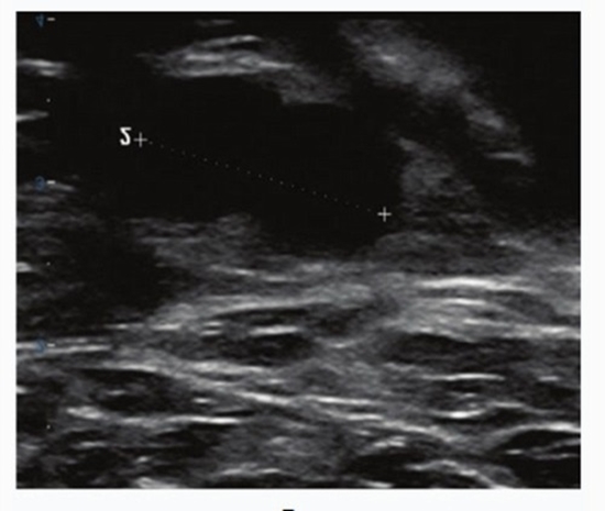 Sonographic With Histological Grade and Biomarker Profiles in Breast Carcinoma {faces}