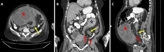 Sigmoid volvulus in a postmenopausal woman with ovarian cyst torsion {faces}