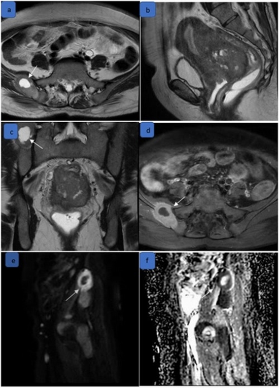 full protocol MRI and modified non-contrast MRI in staging of cervical cancer {faces}